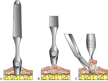 Skin Biopsy - Dr. Novikov Wellness and Skin Care