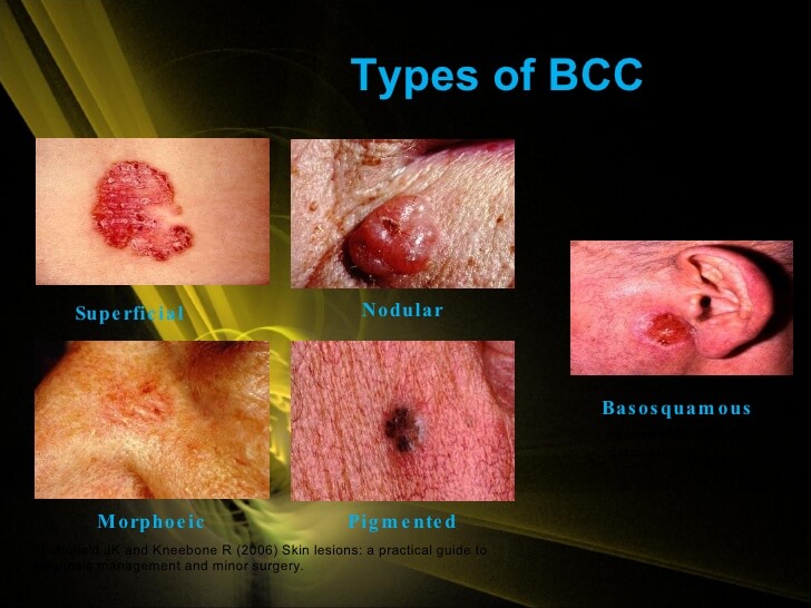 Basal Cell Carcinoma - Dr. Novikov Wellness and Skin Care