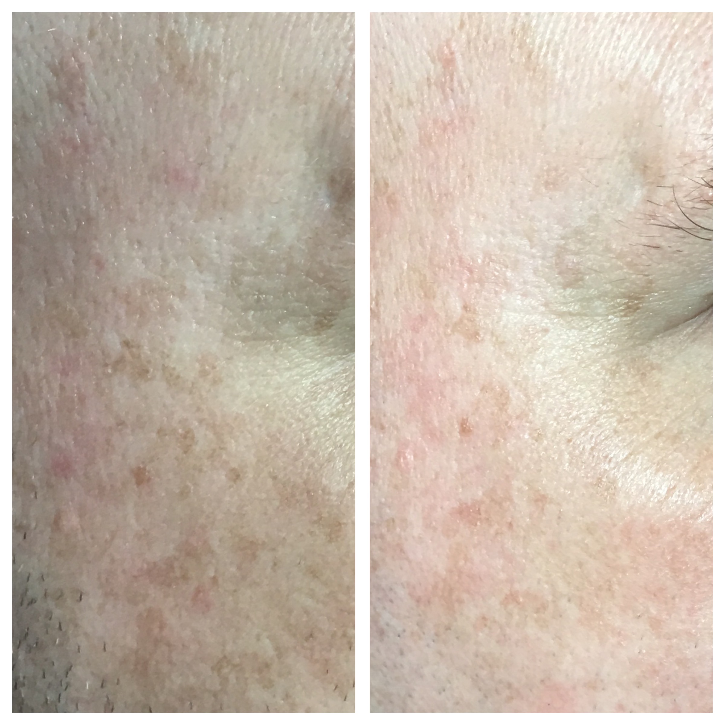 Microneedling for Acne Scars - Dr. Novikov Wellness and Skin Care