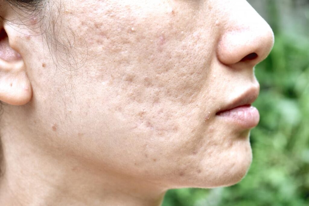 Acne Scars Dr Novikov Wellness And Skin Care