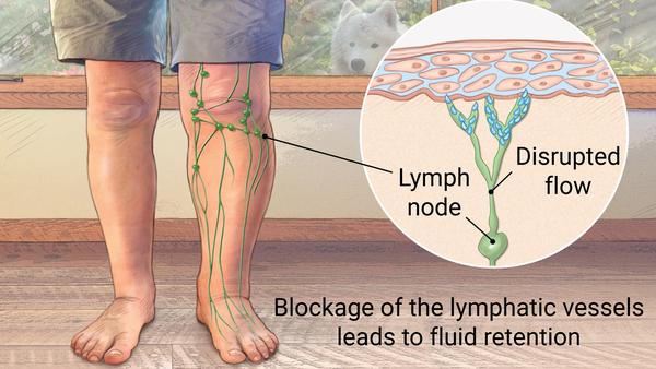 tightness and fluid in knee