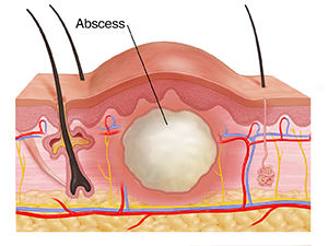 What is an abscess?